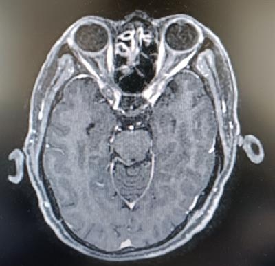 Case Report: Immune Checkpoint Inhibitors Successfully Controlled Asymptomatic Brain Metastasis in Esophageal Squamous Cell Carcinoma